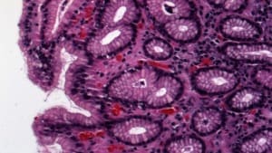 Gamma Filter — After